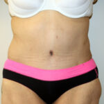 Major Weight Loss Tummy Tuck Before & After Patient #2485