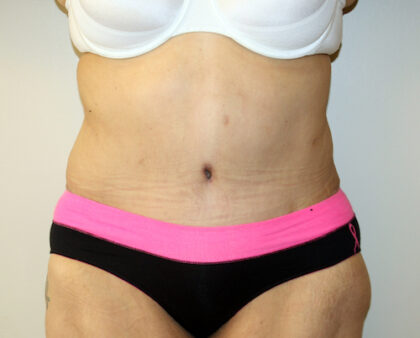 Major Weight Loss Tummy Tuck Before & After Patient #2485