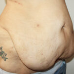 Major Weight Loss Tummy Tuck Before & After Patient #2485