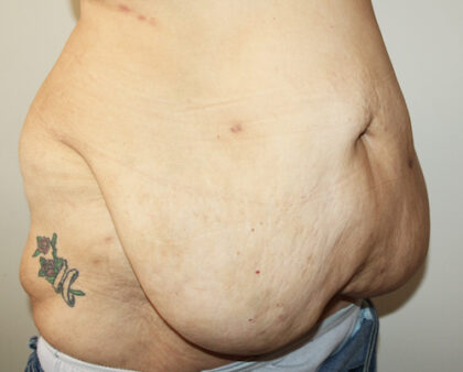 Major Weight Loss Tummy Tuck Before & After Patient #2485