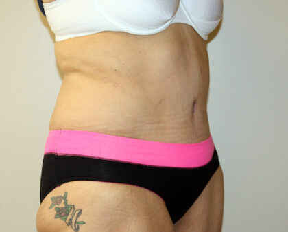 Major Weight Loss Tummy Tuck Before & After Patient #2485