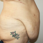 Major Weight Loss Tummy Tuck Before & After Patient #2485