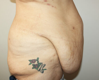 Major Weight Loss Tummy Tuck Before & After Patient #2485