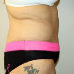 Major Weight Loss Tummy Tuck Before & After Patient #2485