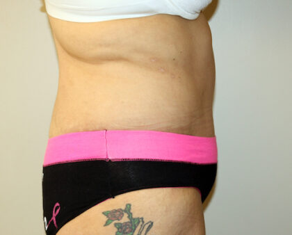 Major Weight Loss Tummy Tuck Before & After Patient #2485