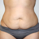 Tummy Tuck Before & After Patient #2611