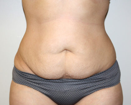 Tummy Tuck Before & After Patient #2611