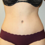 Tummy Tuck Before & After Patient #2611