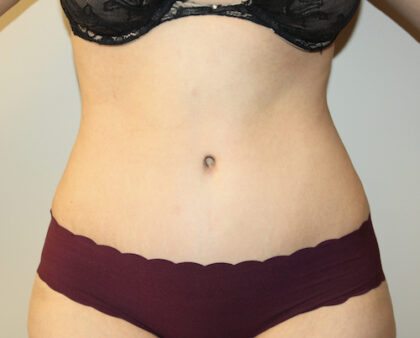 Tummy Tuck Before & After Patient #2611