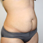 Tummy Tuck Before & After Patient #2611