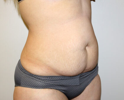 Tummy Tuck Before & After Patient #2611