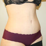 Tummy Tuck Before & After Patient #2611