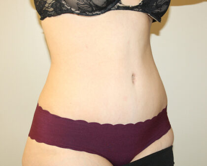 Tummy Tuck Before & After Patient #2611