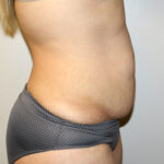 Tummy Tuck Before & After Patient #2611
