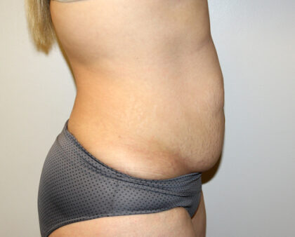 Tummy Tuck Before & After Patient #2611