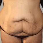 Major Weight Loss Tummy Tuck Before & After Patient #2492