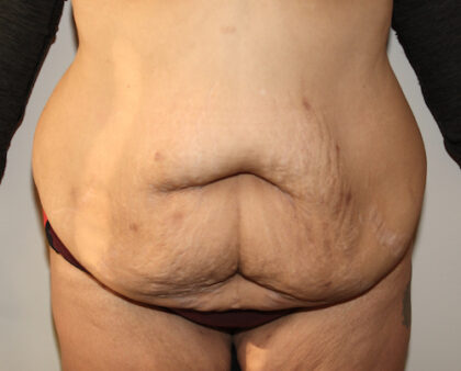 Major Weight Loss Tummy Tuck Before & After Patient #2492