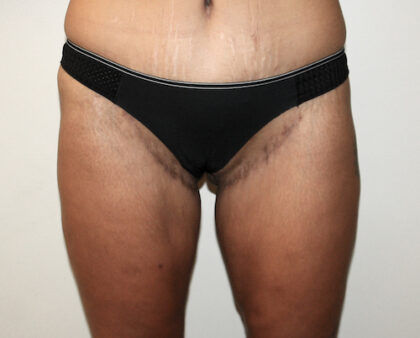 Thigh Lift Before & After Patient #2533