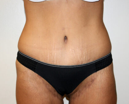 Major Weight Loss Tummy Tuck Before & After Patient #2492