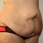 Major Weight Loss Tummy Tuck Before & After Patient #2492