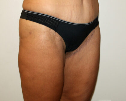 Thigh Lift Before & After Patient #2533