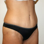 Major Weight Loss Tummy Tuck Before & After Patient #2492