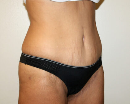 Major Weight Loss Tummy Tuck Before & After Patient #2492