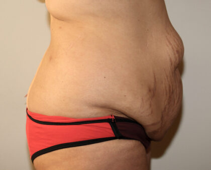 Major Weight Loss Tummy Tuck Before & After Patient #2492