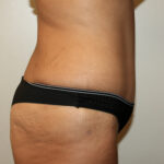 Major Weight Loss Tummy Tuck Before & After Patient #2492