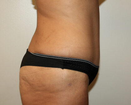 Major Weight Loss Tummy Tuck Before & After Patient #2492