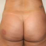 Brazilian Butt Lift Before & After Patient #2299