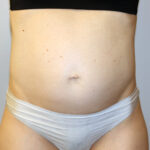 Tummy Tuck Before & After Patient #2632