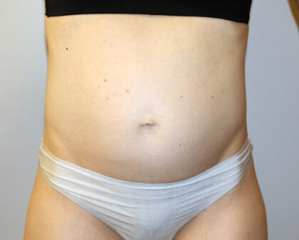 Tummy Tuck Before & After Patient #2632