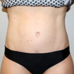 Tummy Tuck Before & After Patient #2632