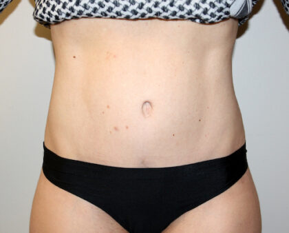 Tummy Tuck Before & After Patient #2632