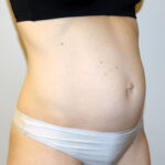 Tummy Tuck Before & After Patient #2632