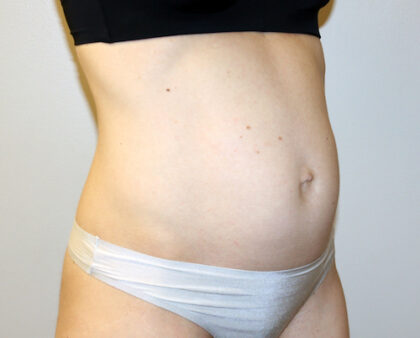 Tummy Tuck Before & After Patient #2632