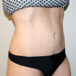 Tummy Tuck Before & After Patient #2632