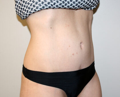 Tummy Tuck Before & After Patient #2632