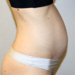 Tummy Tuck Before & After Patient #2632