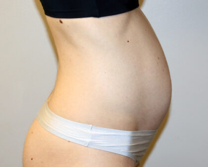 Tummy Tuck Before & After Patient #2632