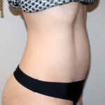 Tummy Tuck Before & After Patient #2632