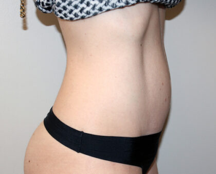Tummy Tuck Before & After Patient #2632