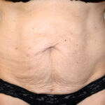 Tummy Tuck Before & After Patient #2618