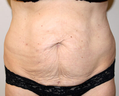 Tummy Tuck Before & After Patient #2618