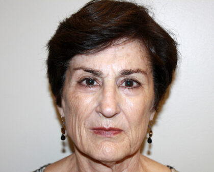 Facelift Before & After Patient #2454