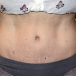 Tummy Tuck Before & After Patient #2618