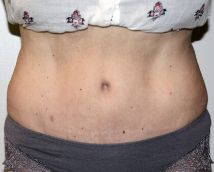 Tummy Tuck Before & After Patient #2618