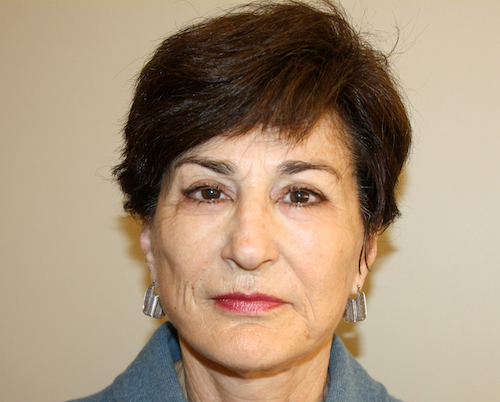 Facelift Before & After Patient #2454
