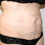 Tummy Tuck Before & After Patient #2618